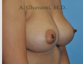 Breast Augmentation Before & After Patient #8884