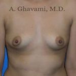 Breast Augmentation Before & After Patient #8884