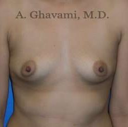 Breast Augmentation Before & After Patient #8884