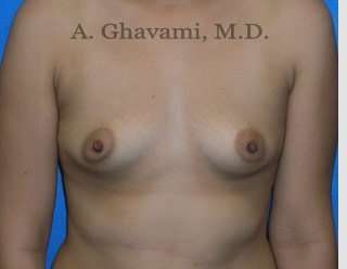 Breast Augmentation Before & After Patient #8884
