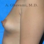 Breast Augmentation Before & After Patient #8884