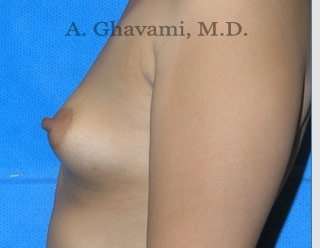 Breast Augmentation Before & After Patient #8884
