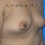 Breast Augmentation Before & After Patient #8884