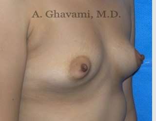 Breast Augmentation Before & After Patient #8884