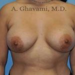 Breast Augmentation Before & After Patient #8877