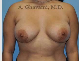 Breast Augmentation Before & After Patient #8877