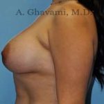 Breast Augmentation Before & After Patient #8877