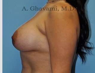 Breast Augmentation Before & After Patient #8877