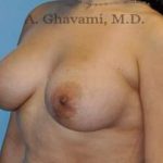 Breast Augmentation Before & After Patient #8877