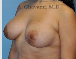 Breast Augmentation Before & After Patient #8877