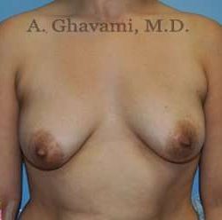 Breast Augmentation Before & After Patient #8877