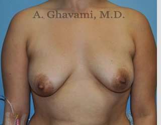 Breast Augmentation Before & After Patient #8877