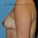 Breast Augmentation Before & After Patient #8877