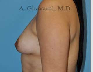 Breast Augmentation Before & After Patient #8877