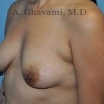 Breast Augmentation Before & After Patient #8877