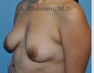Breast Augmentation Before & After Patient #8877