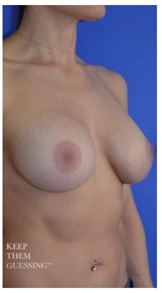 Breast Augmentation Before & After Patient #8870