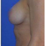 Breast Augmentation Before & After Patient #8870