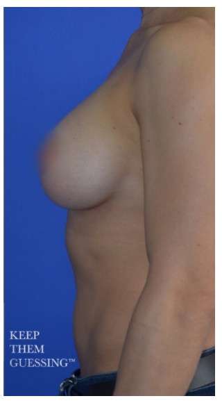 Breast Augmentation Before & After Patient #8870