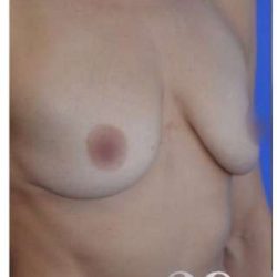 Breast Augmentation Before & After Patient #8870