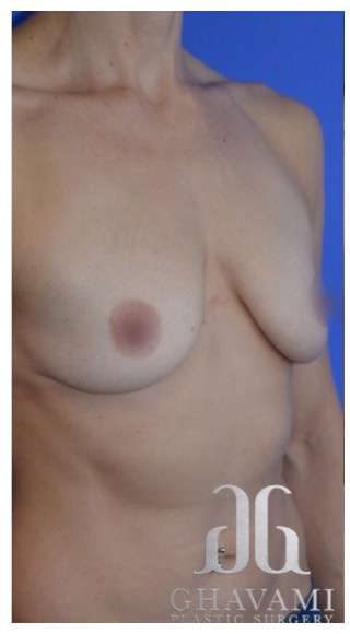 Breast Augmentation Before & After Patient #8870