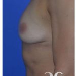 Breast Augmentation Before & After Patient #8870