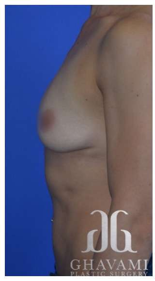 Breast Augmentation Before & After Patient #8870