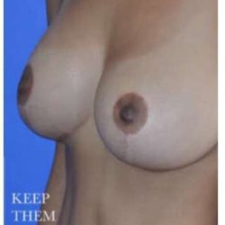 Breast Augmentation Before & After Patient #8865