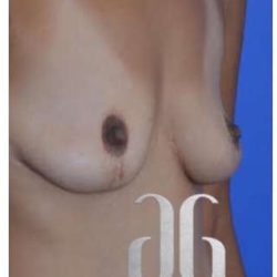 Breast Augmentation Before & After Patient #8865