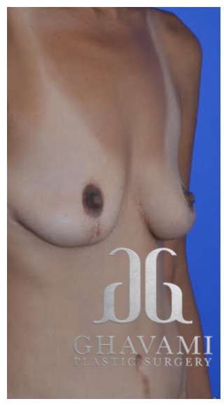 Breast Augmentation Before & After Patient #8865