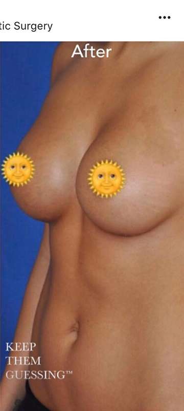 Breast and Body Before & After Patient #8407