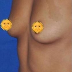 Breast and Body Before & After Patient #8407