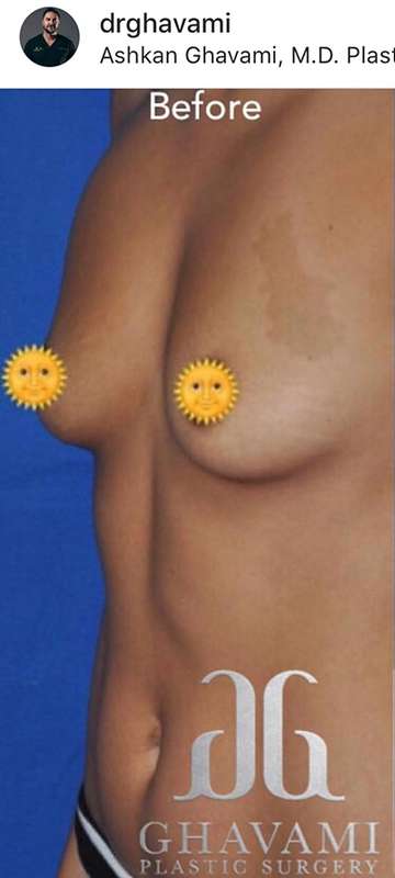 Breast and Body Before & After Patient #8407