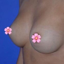 Breast and Body Before & After Patient #8404
