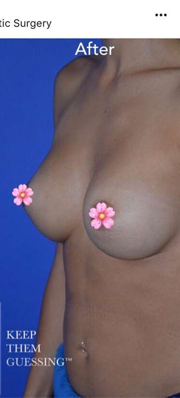 Breast and Body Before & After Patient #8404
