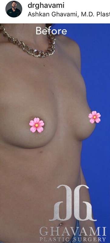 Breast and Body Before & After Patient #8404