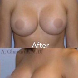 Breast and Body Before & After Patient #8401