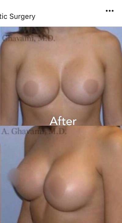 Breast and Body Before & After Patient #8401