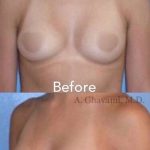 Breast and Body Before & After Patient #8401