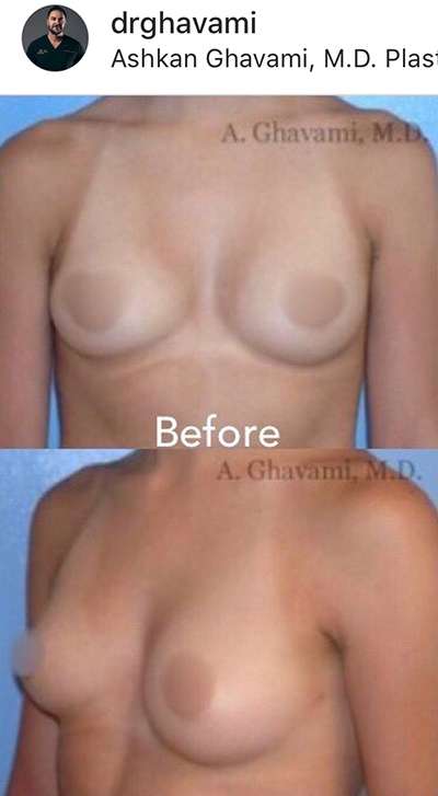 Breast and Body Before & After Patient #8401
