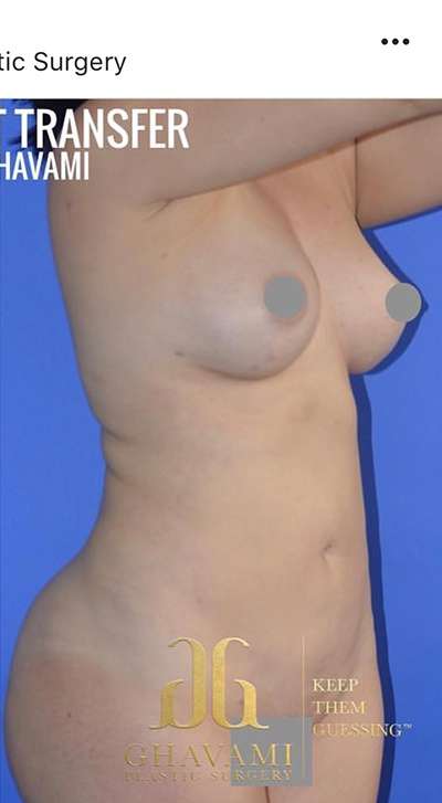 Breast and Body Before & After Patient #8398