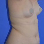 Breast and Body Before & After Patient #8398