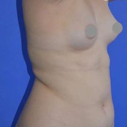 Breast and Body Before & After Patient #8398