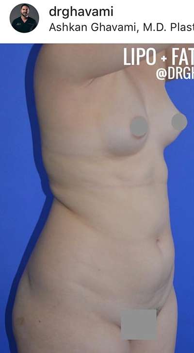 Breast and Body Before & After Patient #8398
