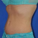 Breast and Body Before & After Patient #8392