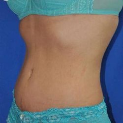 Breast and Body Before & After Patient #8392