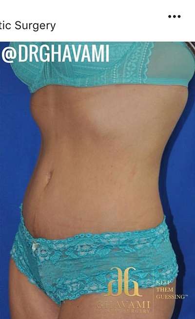 Breast and Body Before & After Patient #8392