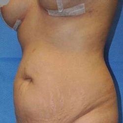 Breast and Body Before & After Patient #8392