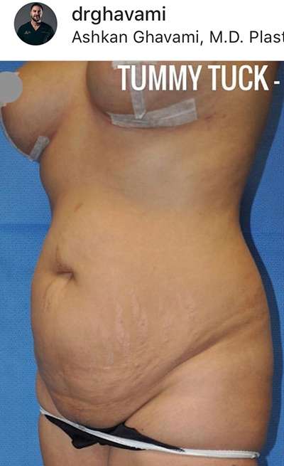 Breast and Body Before & After Patient #8392