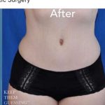 Breast and Body Before & After Patient #8389